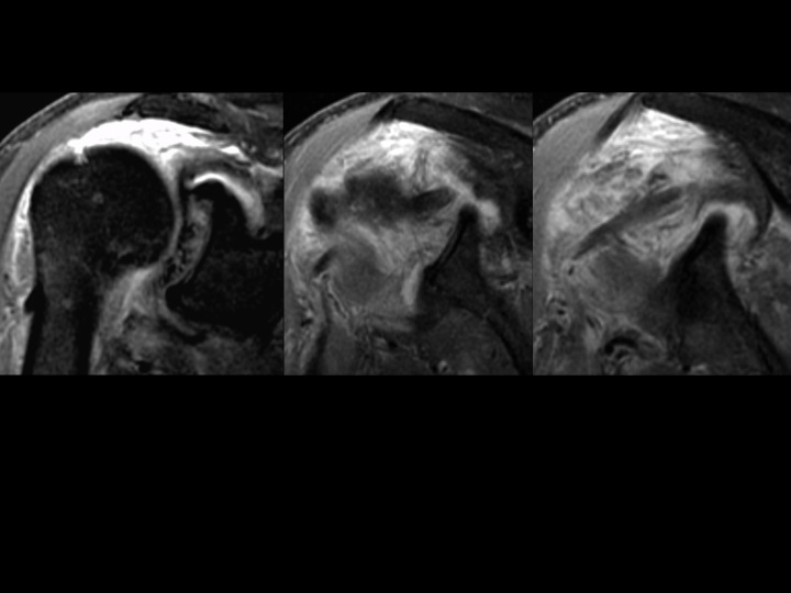 Figure 2 for case tendon of long head of biceps brachii ( RID1944 )